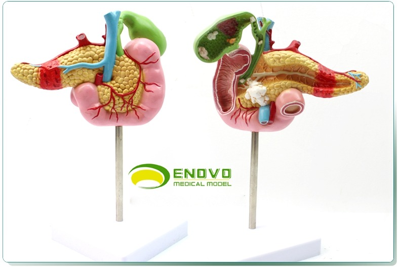 enovo颐诺医学胰腺十二指肠胆囊病理模型胆结石外科消化系统模型